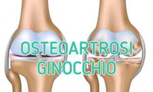 OSTEOARTROSI GINOCCHIO