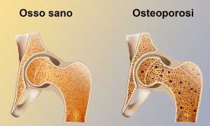 osteoporosi